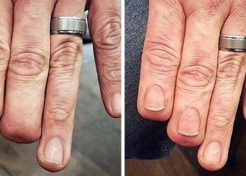 20 alkalom, mikor a tetoválóművészek tökéletesen eltüntették az anyajegyeket és sérüléseket