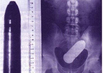 21 bizarr tárgy, amelyet az emberek fenekében találtak az orvosok