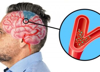 6 figyelmeztető jel, amelyek egy közelgő stroke-ra utalnak, és rendkívül fontos, hogy ismerjük őket