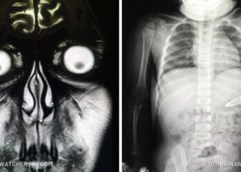 18 furcsa röntgenfotó, amelyen az orvosok is ledöbbentek (szegény Spongyabobon még mindig nem tudom túltenni magam)