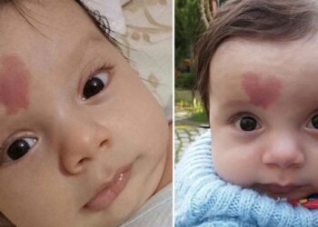 Szív alakú anyajeggyel született, világhírű lett 2015-ben, így néz ki most