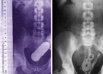 21 bizarr tárgy, amelyet az emberek fenekében találtak az orvosok