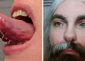 19 személy, akit a genetikai tulajdonságok tettek rendkívül egyedivé és különlegessé