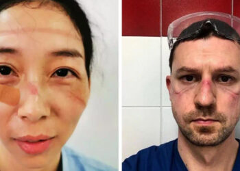 Az egészségügyi dolgozók megmutatták, hogyan néz ki az arcuk a koronavírusos betegek ápolása után