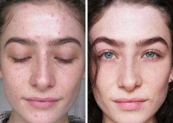 12 személy elmondta, hogyan lett tökéletes bőre. Rengeteget tanulhatunk a történeteikből.