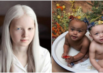 19 személy, akik valóságos genetikai rejtélynek bizonyultak