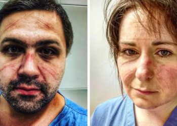 18 kép, mely bemutatja, hogyan néz ki a kórházi dolgozók arca egy fárasztó műszak után