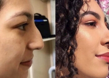 Ezért kellene abbahagyni a plasztikai műtétet választó emberek támadását