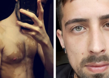 20 személy, akiknek már nem kell kitűnniük a tömegből, mert a természet megtette helyettük