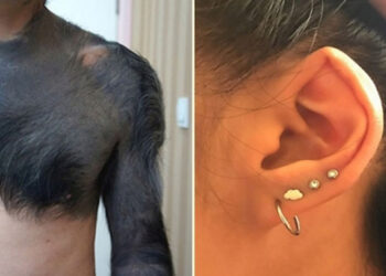 30 személy, akit a genetikai jellemzői és furcsa fizikai képességei tettek egyedivé