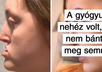 20 személy, aki úgy döntött, hogy plasztikai műtétet csináltat, és csodálatos lett