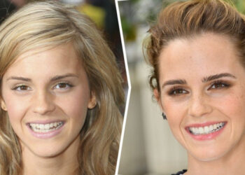 Hogyan változott 15 sztár mosolya, miután rendbe hozták a fogukat