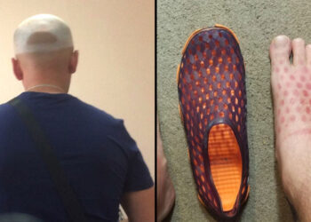 15 személy, aki a lehető legfájdalmasabb módon tanulta meg a naptejek működését