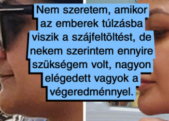 21 személy, akiknek olyan jól sikerült a plasztikai műtét, hogy most 3x gyakrabban néznek a tükörbe