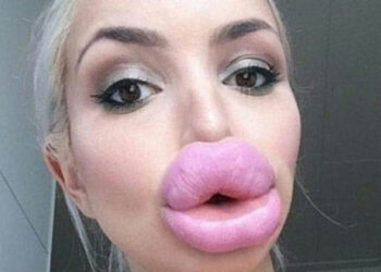 13 nő, aki valószínűleg megbánta, hogy megcsináltatta az ajkait.