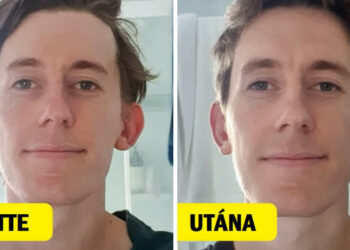 15 személy, akik a plasztikai műtétet választották és hálásak érte