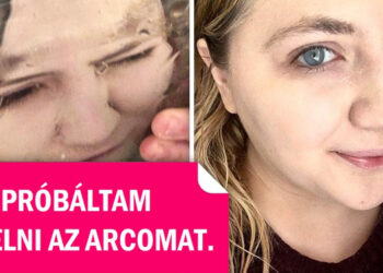 Mi történhet a bőröddel, amennyiben minden nap jéggel dörzsölöd az arcodat