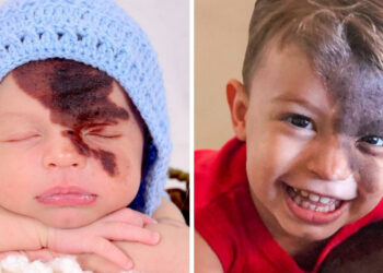 Ismerd meg a kis Enzo-t, akinek anyukája lenyűgöző módot talált arra, hogy megünnepelje egyedi anyajegyét