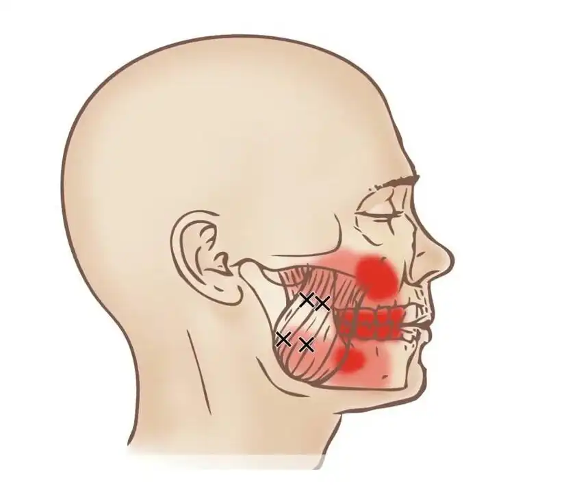 arcápolás, arcfiatalítás, arcmasszázs, botox, bulldozpofa, izomgörcs, kozmetika, lipolízis, megereszkedett bőr, öregedésgátlás, plasztikai sebészet, ránctalanítás, stressz, szálas lifting, szépségápolás, testtartás, toka, ultrahangos feszesítés