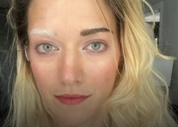 35 lenyűgöző fotó emberekről, akik genetikai rendellenesség miatt különleges megjelenésűek